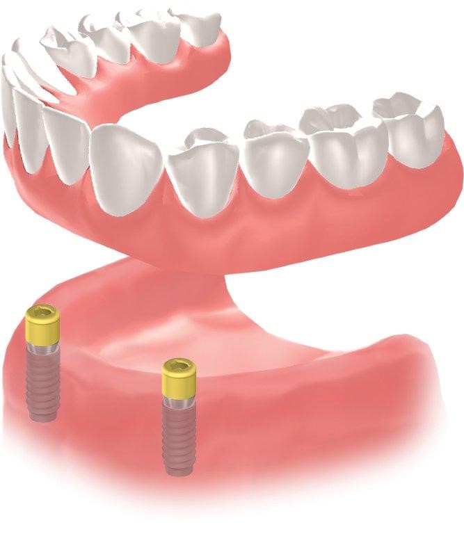 How To Clean Partial Dentures San Antonio TX 78241